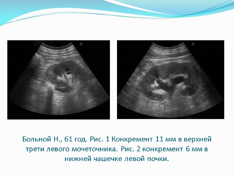 Больной Н., 61 год. Рис. 1 Конкремент 11 мм в верхней трети левого мочеточника.